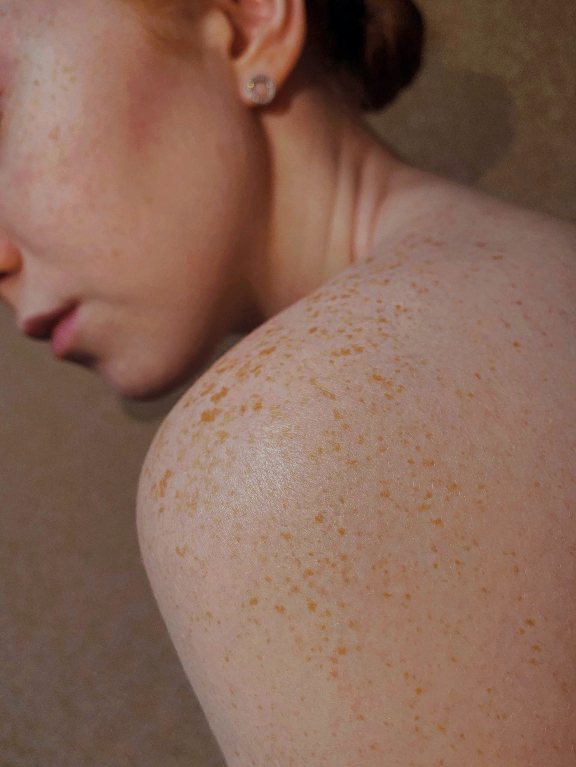 shoulder injection